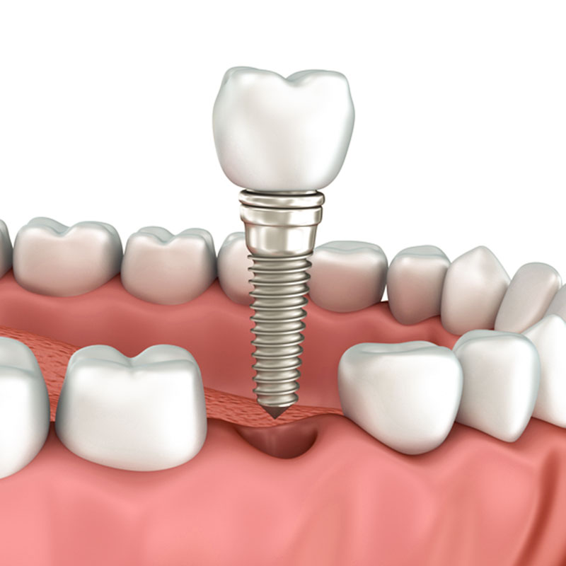 Implantat-fixierter Zahnersatz